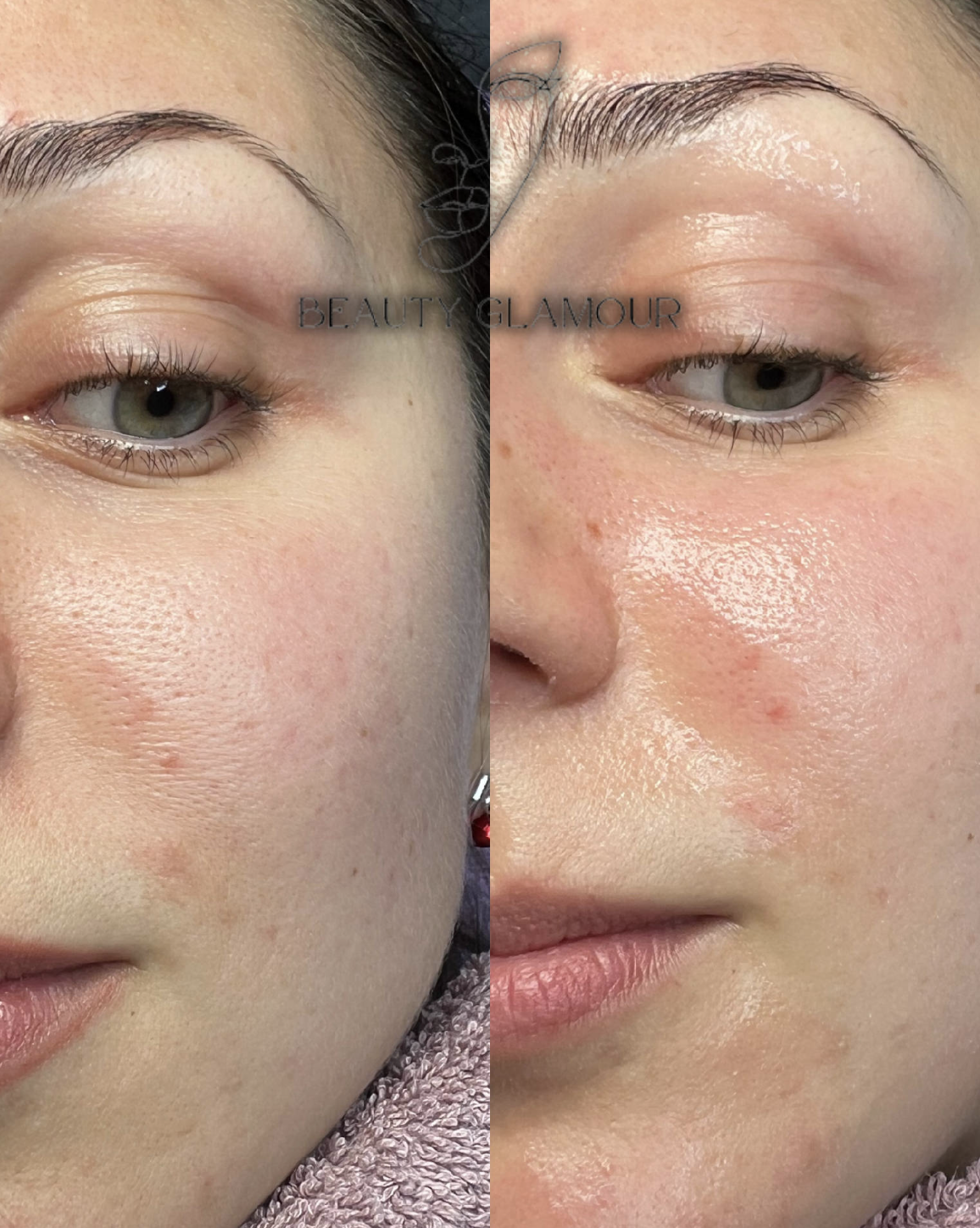 Beauty Glamour — Gesichtsbehandlung Vorher-Nachher